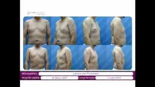 Cosmetic Surgery Gynecomastia enlarged breasts in men