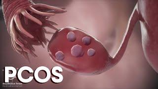 menstruation and  Polycystic Ovary Syndrome or PCOS  Causes TreatmentsDandelion Medical Animation