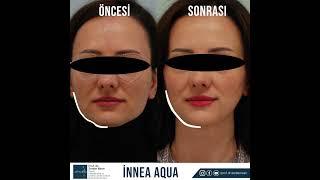 İNNEA AQUA BİYOLOJİK LİFTİNG AŞISI