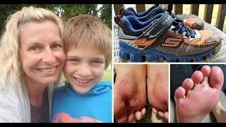 Boy 9 horrifically burnt after light up shoes leak acid over his feet