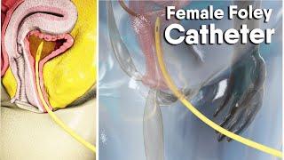 Female Foley Catheter  dandelion medical animation