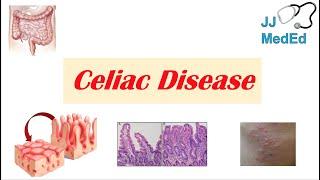 Celiac Disease & Gluten Sensitivity Risk Factors Pathogenesis Symptoms Diagnosis Treatment