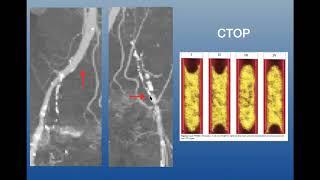 Total Iliac CTO Case