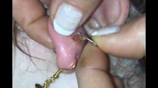 Infected Piercing