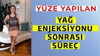 Yüze Yapılan Yağ Enjeksiyonu Sonrası Süreç