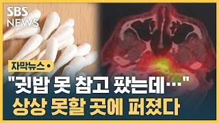 귓밥 못 참고 팠는데… 상상 못할 곳에 퍼졌다 자막뉴스  SBS