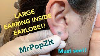 Giant earring completely hidden inside earlobe.Foreign body popMetal extraction.Must see to believe