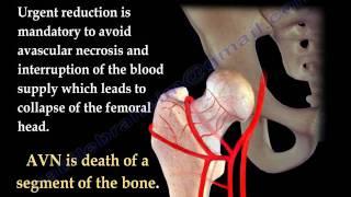 Hip Dislocations - Everything You Need To Know - Dr. Nabil Ebraheim