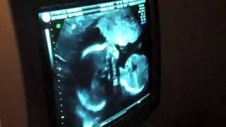 Ultrasound Anatomy Scan - 19 Weeks - MUSC Health