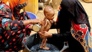 Голод связанный с пандемией убивает детей