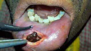 Traumatic Lower Lip Myiasis—A Rare Presentation