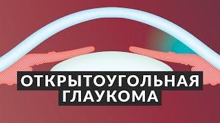 ️ Открытоугольная глаукома ️ 5 фактов об открытоугольной глаукоме Доктор Лапочкин