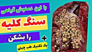 سنگ کلیه چجوری دفع میشه درمان سریع سنگ کلیه با این گیاه سنگ شکن که شگفت زده میشوید 