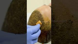 Step-by-Step Guide to Washing Your Hair After Transplant Surgery  Dadu Medical Centre