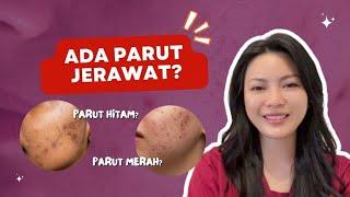 Beauty Tips  Masalah jerawat tinggalkan parut HITAM dan parut MERAH?