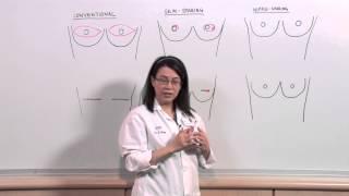 Types of Mastectomies What is nipple-sparing reconstruction? - Sonia Sugg MD