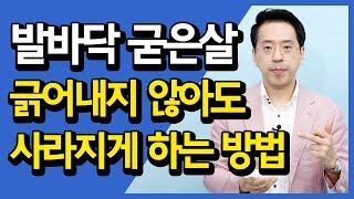 통사장 발바닥 굳은살과 티눈 제거하는 방법│긁어서 제거하는 방법 NO 알아서 사라지는 방법