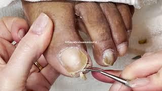 Best Pedicure Transformation - Clients Toenail Journey