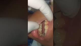 Dental Plaque Tebal Seperti Ini Adalah Awal Dari Kerusakan Gigi mu waspadalah