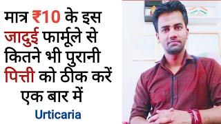 Treatment of Urticaria खुजली व जलन होना urticaria  BY Dr Tarun Chauhan