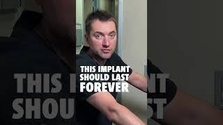 Dental Implants Should Last Forever