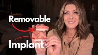 Do Implants Look Better Than Dentures?