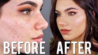 Cover ACNE with DRUGSTORE Makeup & Brushes FULL COVERAGE Foundation