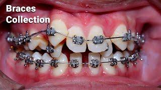 braces process collection