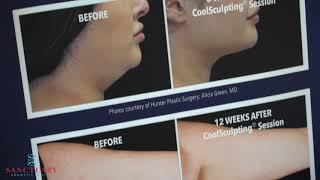 Does CoolSculpting Work?