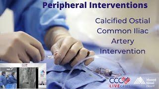 Calcified Ostial Common Iliac Artery Intervention - Peripheral Interventions August 2021