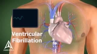AED - 3D Medical Animation