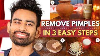 ULTIMATE Ayurvedic Routine to Get Rid of Pimples & Acne Permanently Men & Women