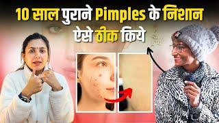 क्या 10 साल पुराने Pimples के निशान गड्ढे ठीक हो सकते हैं ?  Patient Review  Dr. Upasana Vohra