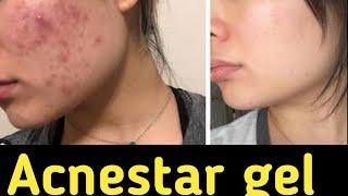 acnestar gel  best cream for acne  #Shorts