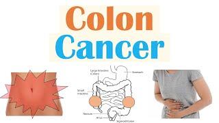 Colon Cancer CRC Risk Factors Pathogenesis Symptoms Diagnosis Staging Treatment