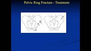 20  Pediatric Pelvic and Acetabular Fractures   Nirav Pandya MD