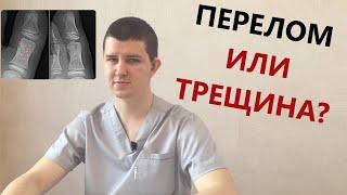 Перелом или трещина?  Доктор Драганик