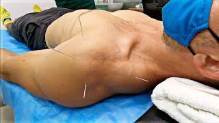 Acupuncture in China - Does It Relieve Pain?
