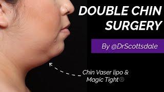 JAWLINE CONTOURING SURGERY by @DrScottsdale - Double Chin Lipo