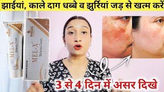 MEL-X melasma cream full review in hindi  झाईयों को साफ करने की बेस्ट होम्योपैथिक क्रीम 2024