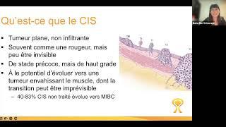 Cancer de la vessie Comprendre le carcinome in situ