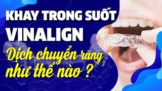 Khay Niềng Răng Trong Suốt Vinalign Dịch Chuyển Răng Thế Nào?  Nam Bui Vinalign