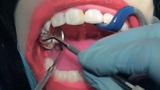 ASMR Dental Exam  Scaling & Cavities  Dentist & Patient POV