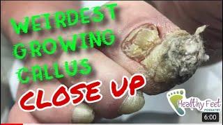 CLOSE UP LOOK at the Weirdest Growing Callus