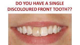 Do You Have a Single Discoloured Front tooth?