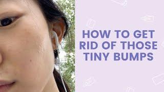 How to Get Rid of Those Tiny Bumps  FaceTory