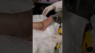 reduccion de fractura luxacion de tobillo  #articulacion #contusion #tobillo #ankle #caida