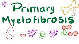 Primary Myelofibrosis PMF  Myeloproliferative Neoplasm Bone Marrow Fibrosis