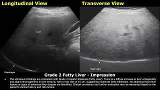 Grade 2 Fatty Liver Ultrasound Report Example  Diffuse Hepatic Steatosis Sonography  Abdominal USG