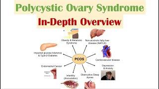 Polycystic Ovary Syndrome PCOS  Overview of Associated Conditions Diagnosis & Treatments